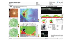 glaucoma report gcl rnfl nervo ottico 